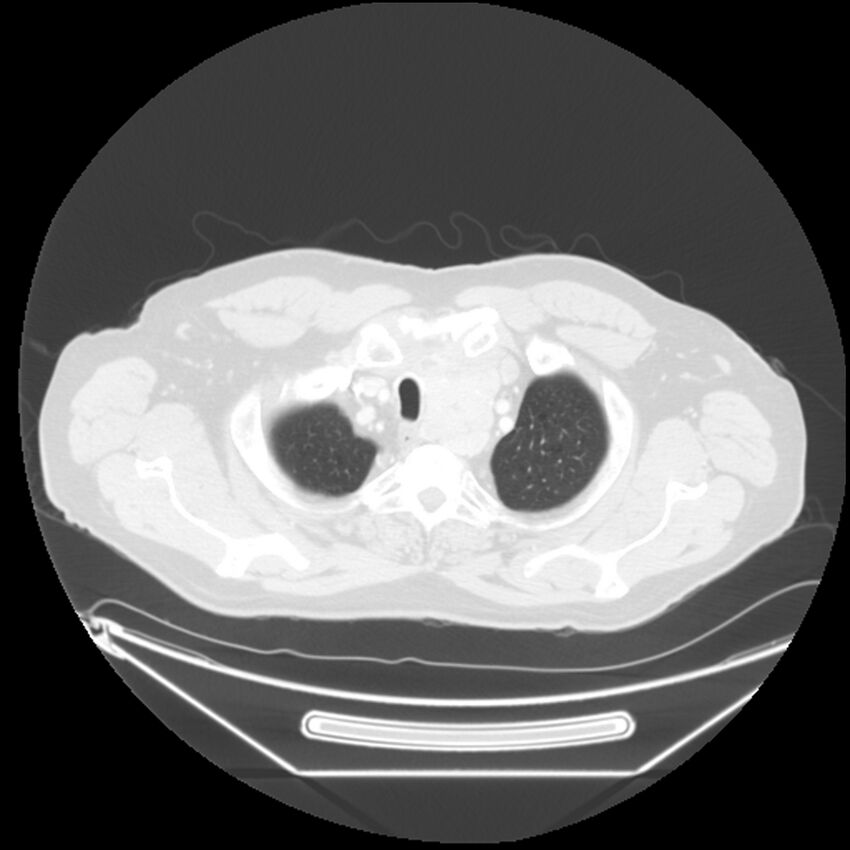 Adenocarcinoma of the lung (Radiopaedia 44876-48759 Axial lung window 6).jpg