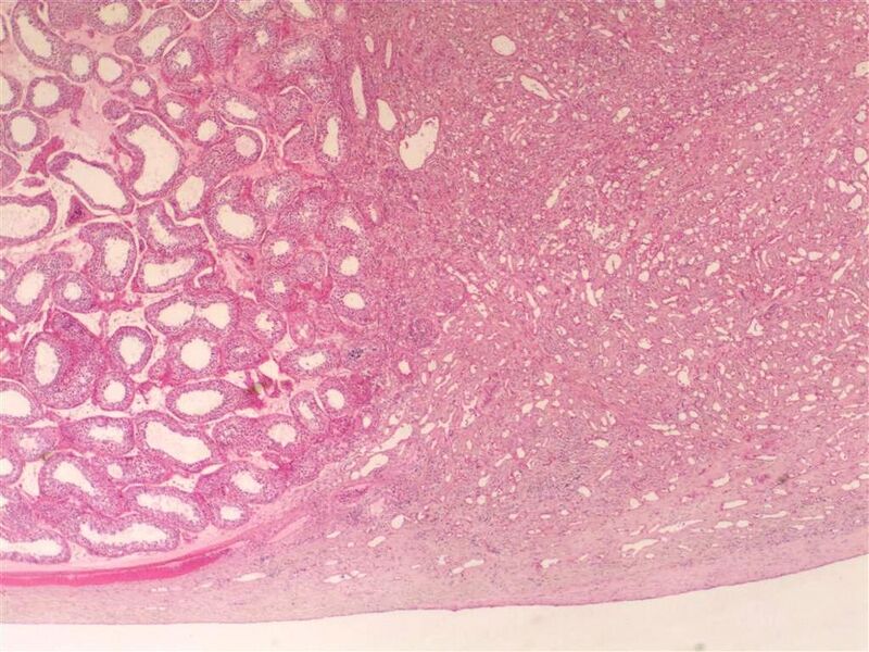 File:Adenomatoid tumor of the scrotum (pathology) (Radiopaedia 16175-15853 H&E 1).jpg