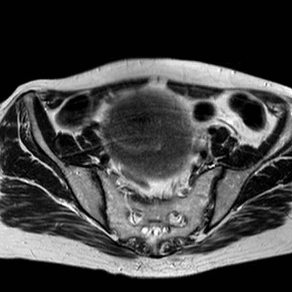 File:Adenomyoma of the uterus (huge) (Radiopaedia 9870-10438 Axial T2 29).jpg