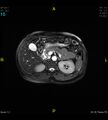 Adenomyosis (Radiopaedia 43504-46889 Axial 2D FIESTA 15).jpg