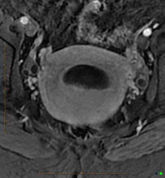 File:Adenomyosis uterus with hematometra (Radiopaedia 45779-50011 Axial T1 C+ fat sat 36).jpg