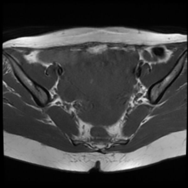 File:Adenomyosis within a septate uterus (Radiopaedia 69963-79981 Axial T1 14).jpg