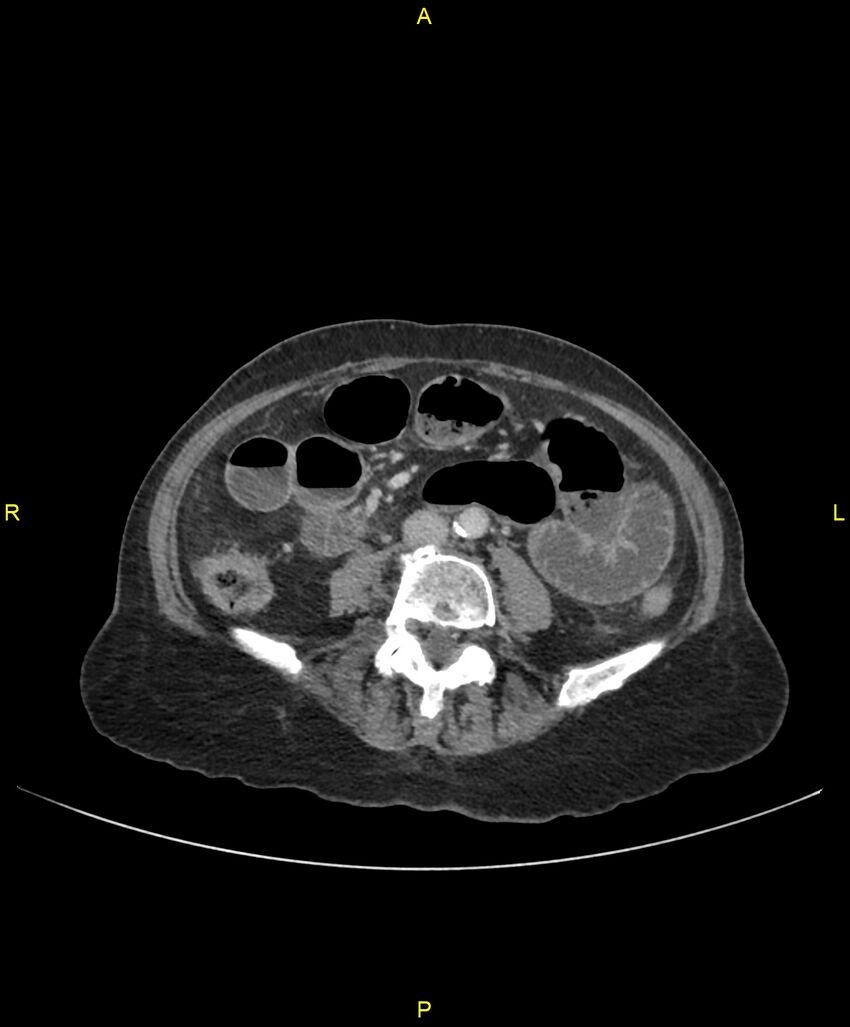Adhesional small bowel obstruction (Radiopaedia 85402-101024 Axial C+ portal venous phase 164).jpg