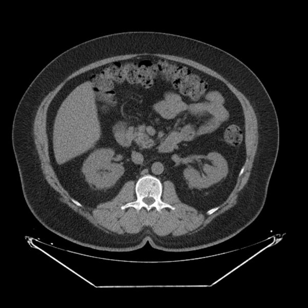 File:Adrenal myelolipoma (Radiopaedia 26278-26407 Axial non-contrast 27).jpg