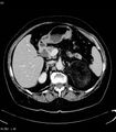 Adrenal myelolipoma (Radiopaedia 6765-7960 Axial C+ arterial phase 10).jpg