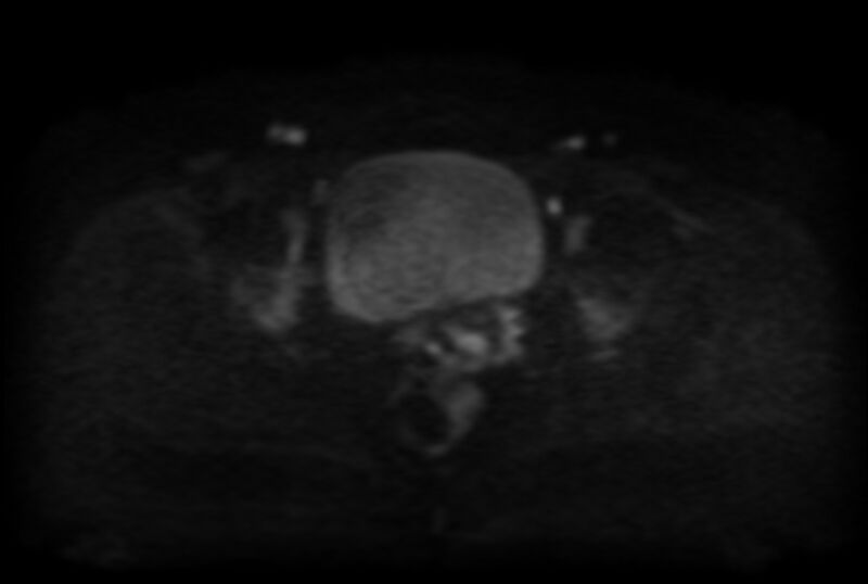 File:Adult granulosa cell tumor of the ovary (Radiopaedia 71581-81950 Axial DWI 18).jpg