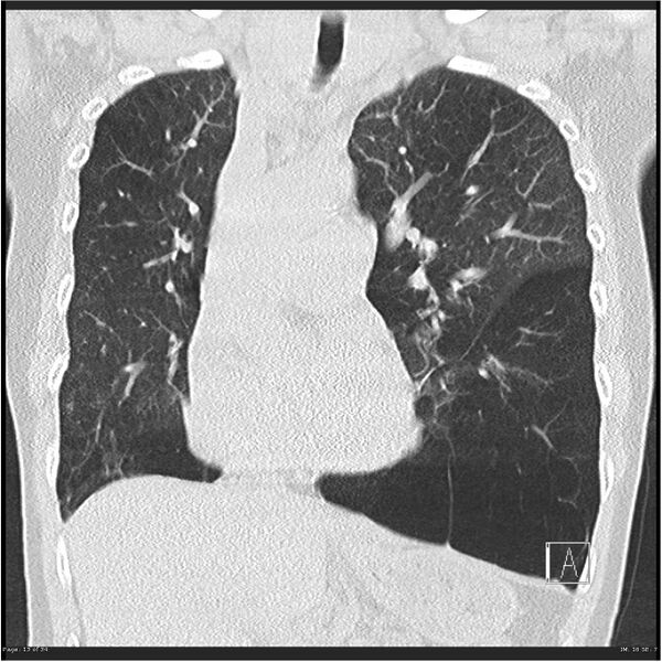 File:Alpha-1-antitrypsin deficiency (Radiopaedia 26537-26678 Coronal lung window 13).jpg