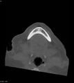 Ameloblastoma (Radiopaedia 18115-17901 Axial bone window 16).jpg