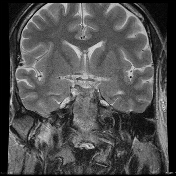 File:Amnestic syndrome secondary to hypoxic brain injury (Radiopaedia 24743-25004 F 12).jpg
