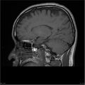 Amnestic syndrome secondary to hypoxic brain injury (Radiopaedia 24743-25004 T1 7).jpg