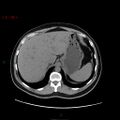 Ampullary carcinoma (Radiopaedia 56396-63056 Axial non-contrast 11).jpg