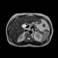 Ampullary tumor (Radiopaedia 27294-27479 T2 17).jpg