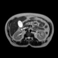 Ampullary tumor (Radiopaedia 27294-27479 T2 7).jpg