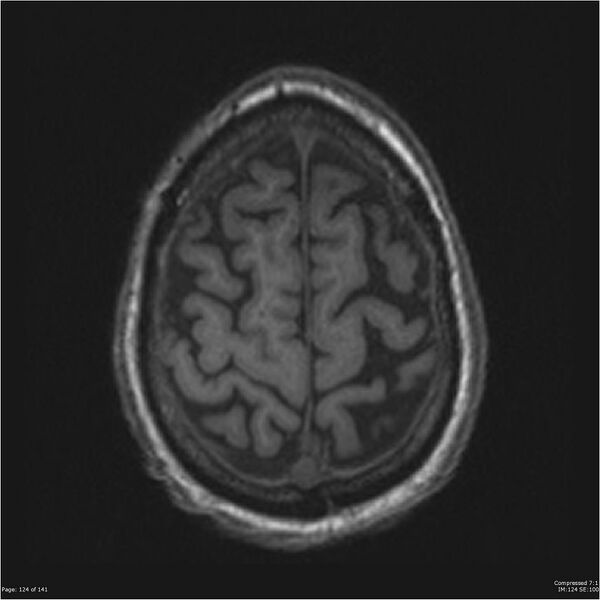 File:Anaplastic meningioma with recurrence (Radiopaedia 34452-35788 Axial T1 122).jpg