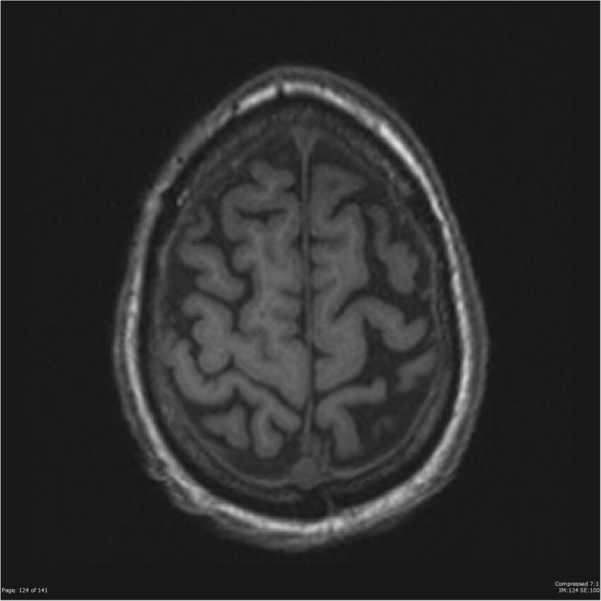 Anaplastic meningioma with recurrence (Radiopaedia 34452-35788 Axial T1 122).jpg