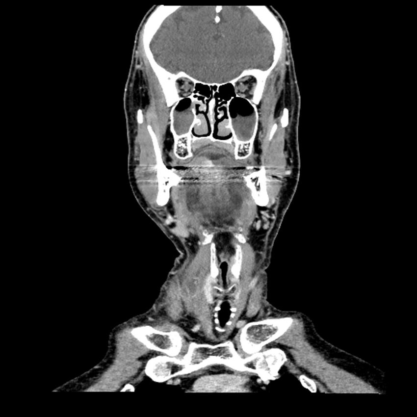 Anaplastic thyroid carcinoma (Radiopaedia 79087-92034 A 46).jpg