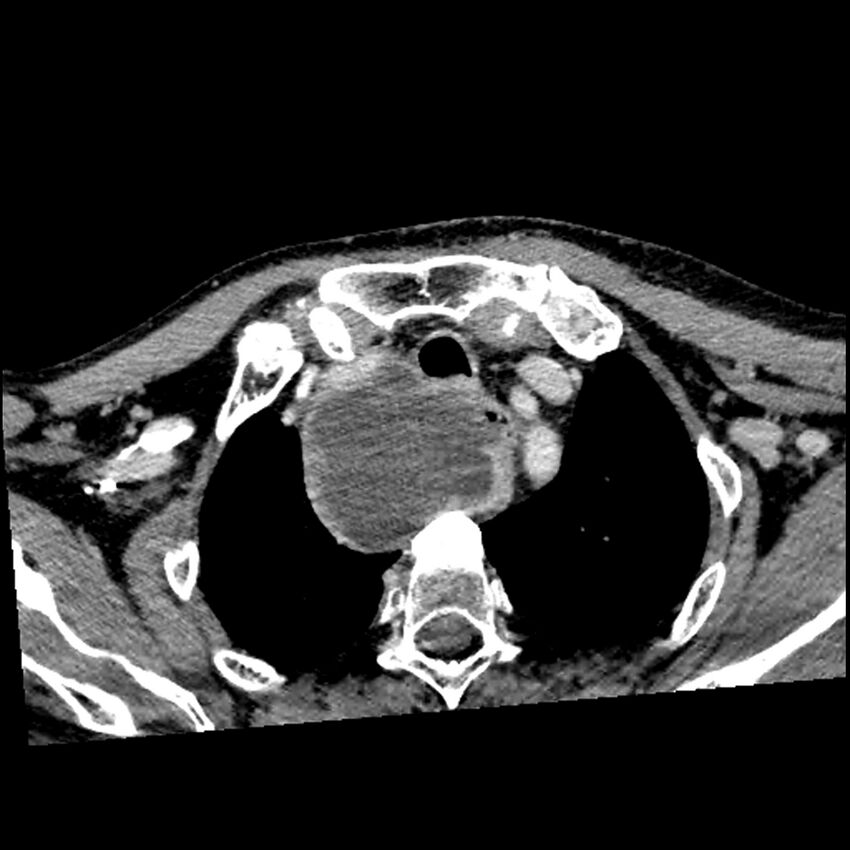 Anaplastic thyroid carcinoma (Radiopaedia 79087-92034 B 21).jpg
