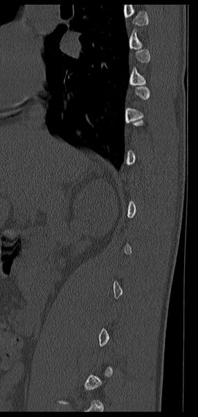 File:Aneurysmal bone cyst T11 (Radiopaedia 29294-29721 Sagittal bone window 60).jpg