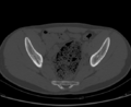 Aneurysmal bone cyst of ischium (Radiopaedia 25957-26094 Axial bone window 38).png