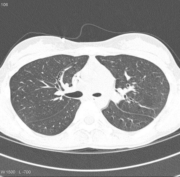 File:Angioinvasive aspergillosis (Radiopaedia 8651-9466 Axial lung window 1).jpg