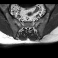 Ankylosing spondylitis with zygapophyseal arthritis (Radiopaedia 38433-40517 B 7).jpg