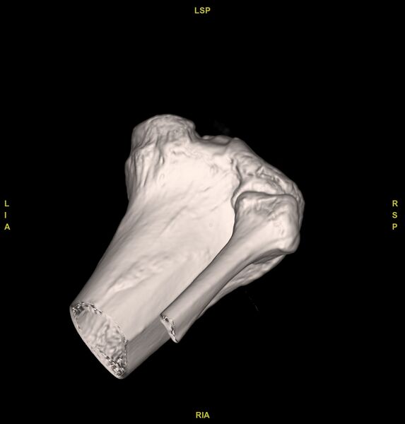 File:Anterior cruciate ligament avulsion fracture (Radiopaedia 58939-66194 VRT 11).jpg