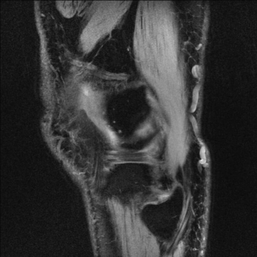 Anterior cruciate ligament mucoid degeneration (Radiopaedia 68400-77933 Sagittal 5).jpg