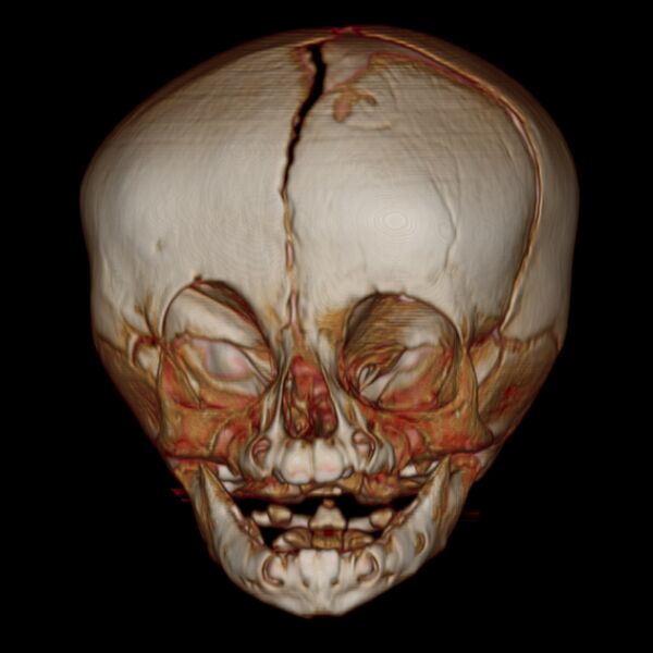 File:Anterior plagiocephaly (Radiopaedia 71836-82273 E 1).jpg