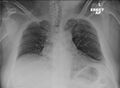 Anterior shoudler dislocation on chest radiograph (Radiopaedia 87418).jpg