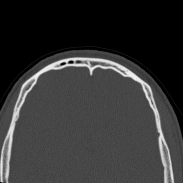 File:Antrochoanal polyp (Radiopaedia 21894-21868 Axial bone window 48).jpg