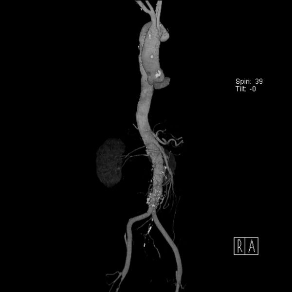 File:Aortic arch saccular aneurysm (Radiopaedia 19430-19457 A 17).jpg
