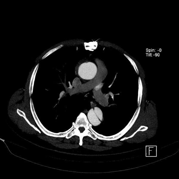 File:Aortic dissection - De Bakey type III - Stanford B (Radiopaedia 21903-21882 B 25).jpg