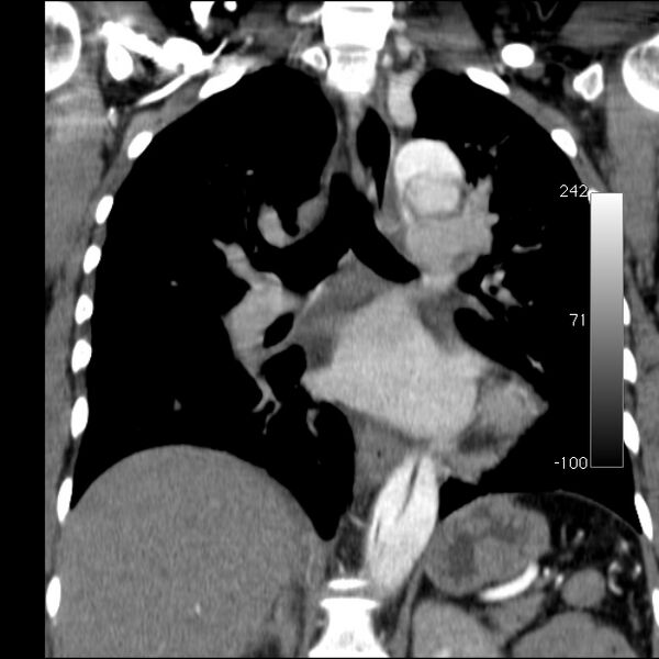 File:Aortic dissection - Stanford type A (Radiopaedia 29247-29659 B 36).jpg
