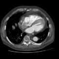 Aorto-coronary bypass graft aneurysms (Radiopaedia 40562-43157 A 85).png
