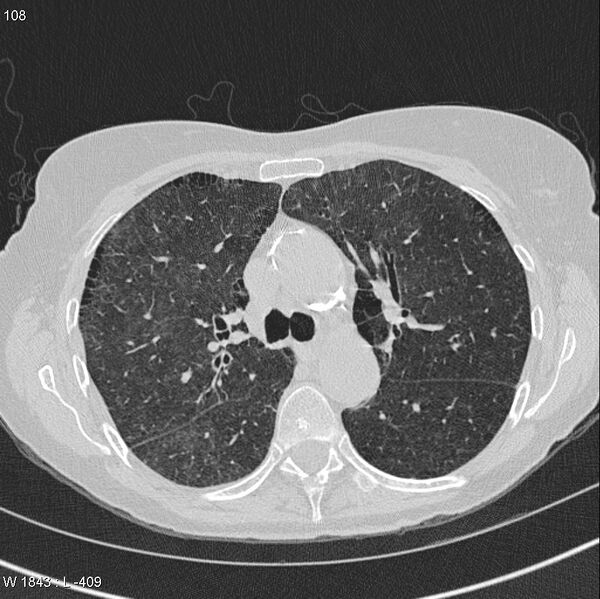 File:Apical non-small-cell lung cancer (Radiopaedia 8570-9405 Axial lung window 17).jpg