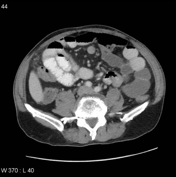 File:Appendicitis (Radiopaedia 27446-27642 A 23).jpg