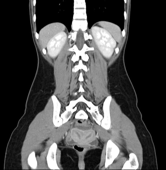 File:Appendicitis and incidental bicornuate uterus (Radiopaedia 22833-22853 D 35).jpg