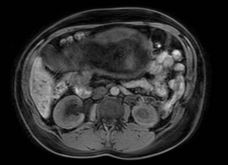 File:Appendicitis in gravida (MRI) (Radiopaedia 89433-106395 Axial DIXON 56).jpg