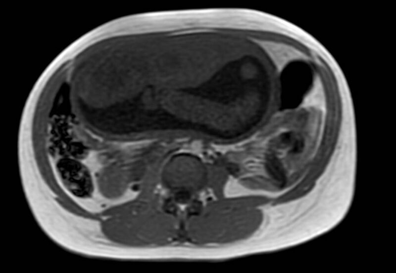 File:Appendicitis in gravida (MRI) (Radiopaedia 89433-106395 Axial T1 in-phase 32).jpg