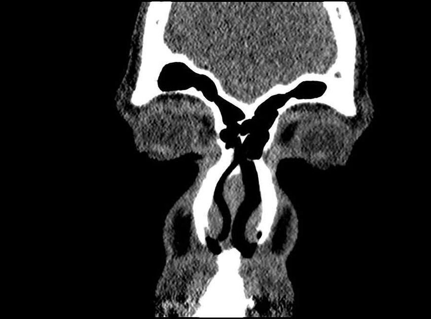Arachnoid cyst- extremely large (Radiopaedia 68741-78450 Coronal bone window 70).jpg