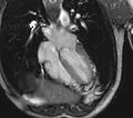 Arrhythmogenic right ventricular cardiomyopathy (Radiopaedia 39806-42237 D 80).jpg