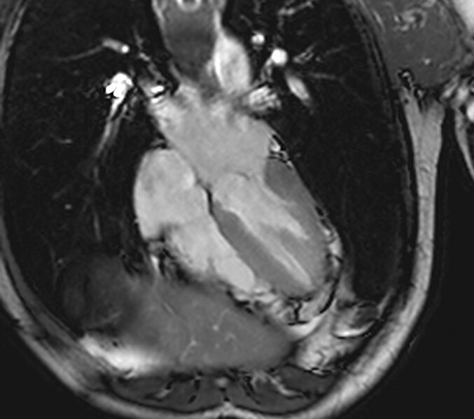 File:Arrhythmogenic right ventricular cardiomyopathy (Radiopaedia 39806-42237 D 83).jpg