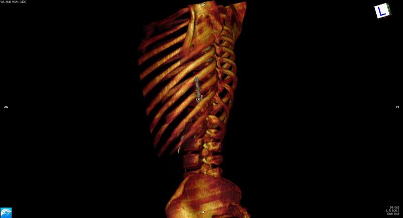 File:Arrow injury to the chest (Radiopaedia 75223-86321 3D bone 14).jpg