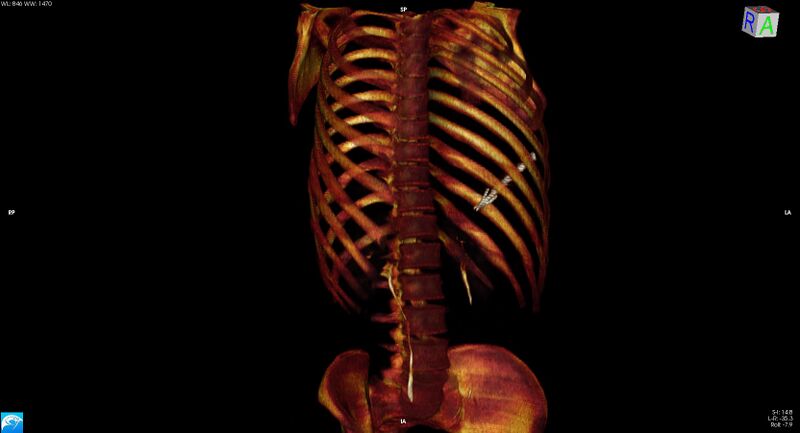File:Arrow injury to the chest (Radiopaedia 75223-86321 3D bone 39).jpg
