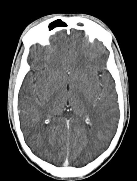 File:Arrow injury to the face (Radiopaedia 73267-84011 Axial C+ delayed 53).jpg