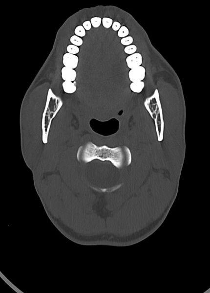File:Arrow injury to the head (Radiopaedia 75266-86388 Axial bone window 31).jpg