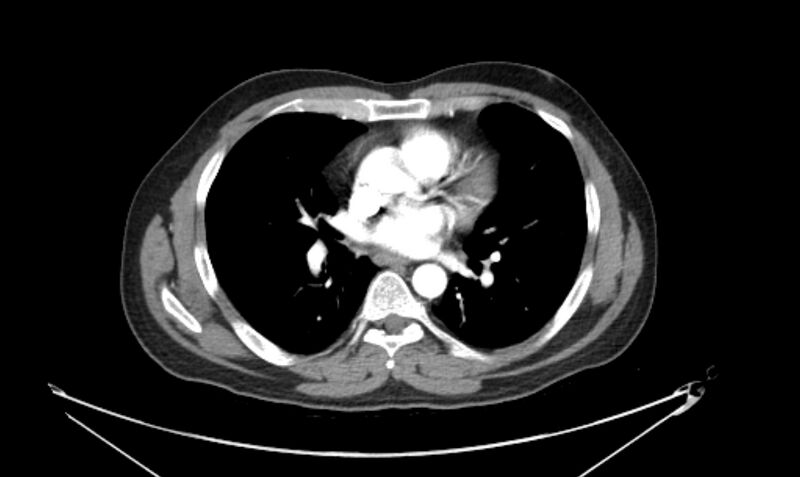 File:Arterial occlusive mesenteric ischemia (Radiopaedia 84641-100060 A 4).jpg