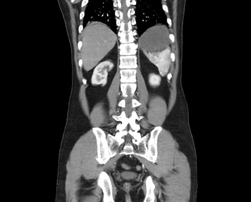 Arterial occlusive mesenteric ischemia (Radiopaedia 84641-100060 B 43).jpg