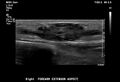 Arteriovenous malformation of the soft tissues (Radiopaedia 87432).jpg