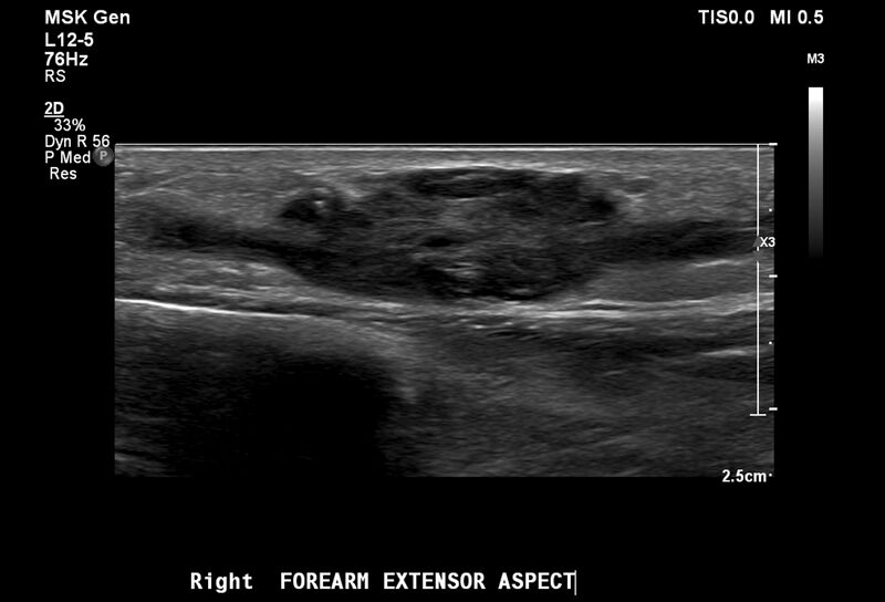 File:Arteriovenous malformation of the soft tissues (Radiopaedia 87432).jpg